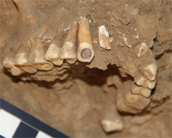 An excavated human skull with dental inlays.