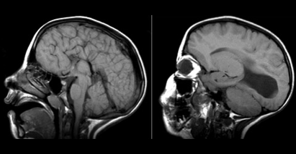 These brain images show agenesis (absence) of the set of fibers connecting the two halves of the brain in children with fetal alcohol syndrome