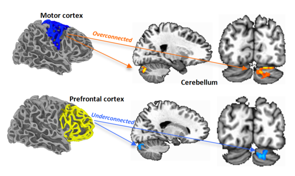 These fMRI scans show regions of over- and underconnectivity between the cerebellum and cerebral cortex in young people with autism spectrum disorder.